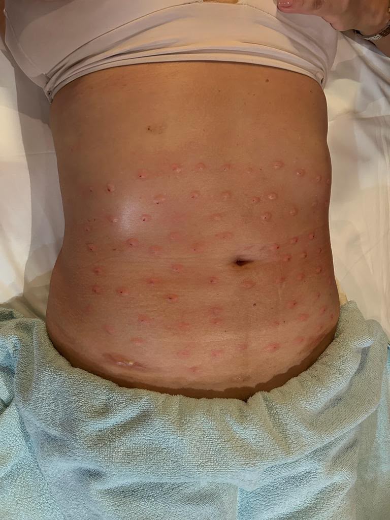 Mesoterapia